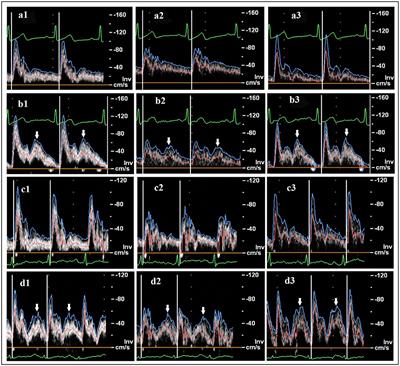 Hemodynamic Responses in Carotid Bifurcation Induced by Enhanced External Counterpulsation Stimulation in Healthy Controls and Patients With Neurological Disorders